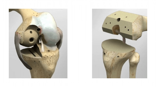 Εικόνα 4:  Περιορισμένες  οστεοτομίες μόνον στον φθαρμένο τμήμα της άρθρωσης (αριστερά) συγκριτικά με τις εκτεταμένες οστεοτομίες στην ολική αρθροπλαστική (δεξιά).