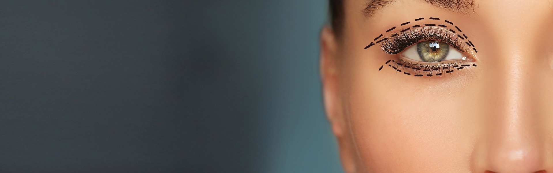 βλεφαροπλαστική