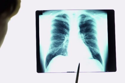 Κρυοβιοψία